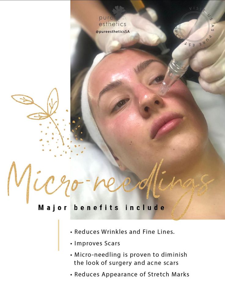 Micro Needling